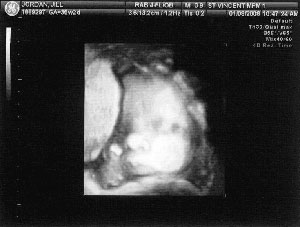 Reid ultrasound