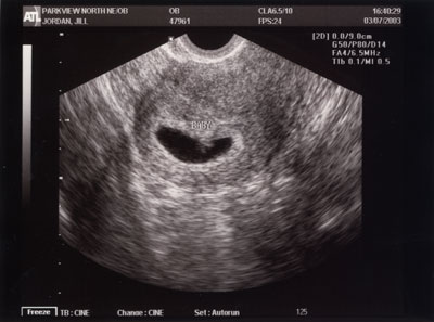 baby2-1st-ultrasound.jpg
